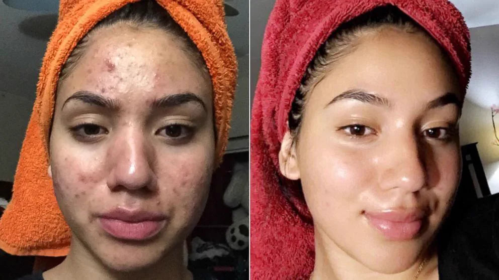 Esmarelda, 23 before and after